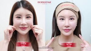 ไม่ใช่แค่หน้า! โปรแกรม Thermage FLX ทำตรงไหนได้อีกบ้าง?