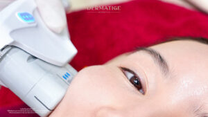 อัปเกรดความปัง! โปรแกรม Ultherapy PRIME ต่างจากโปรแกรม Ultherapy รุ่นเก่ายังไง?