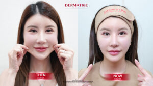 เปิดหมดเปลือกก่อนตัดสินใจทำโปรแกรม Thermage FLX เจ็บไหม?