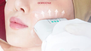 เจาะลึกเทคโนโลยี “โปรแกรม Ultherapy Prime” ยิงผิวชั้นไหน ทำไมถึงดีกว่า?