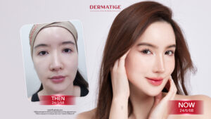 โปรแกรม หน้ายุง Prime โปรแกรมยกหน้าสู้แรงโน้มถ่วงแบบไม่ต้องผ่าตัด