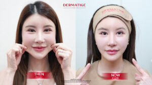 โปรแกรม Thermage FLX คืออะไร? ทำไมใครๆ ก็บอกว่าเป็นตัวแม่เรื่อง “ผิวแน่นฟู หน้าเด็ก!”