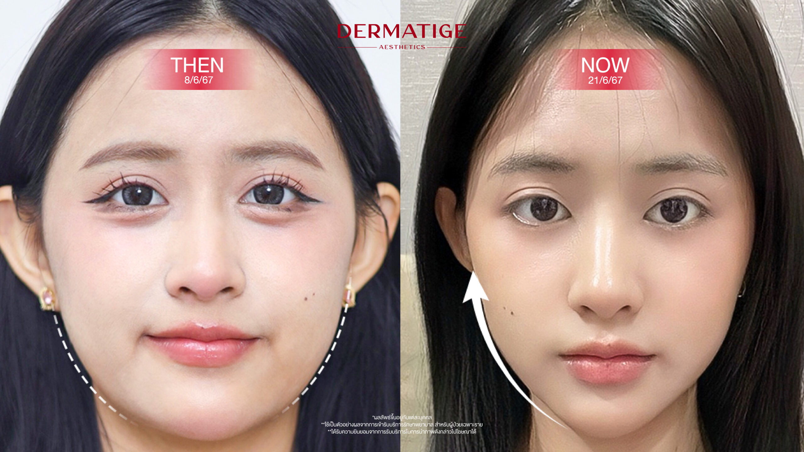 เจาะลึก “หัวยิงโค้งมน” ของ โปรแกรม Volnewmer มันดียังไง? ทำไมถึงแนบสนิทกับผิวได้ดีกว่า?