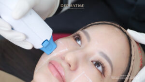 เจาะลึกหัวยิง 4 สีของ โปรแกรม Thermage FLX!