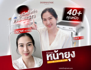 หน้าห้อยหลังคลอดแก้ได้! ส่องรีวิว "โปรแกรมหน้ายุง Prime" หน้ายกจนตกใจ ความเจ็บทนได้ ผลลัพธ์เกินคาด
