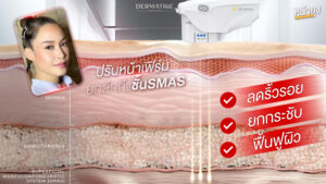 44 ยังเป๊ะ คุณเมย์พิสูจน์ “โปรแกรมหน้ายุง Prime” ที่ “Dermatige” ทางออกของคนไม่สะดวกแก่