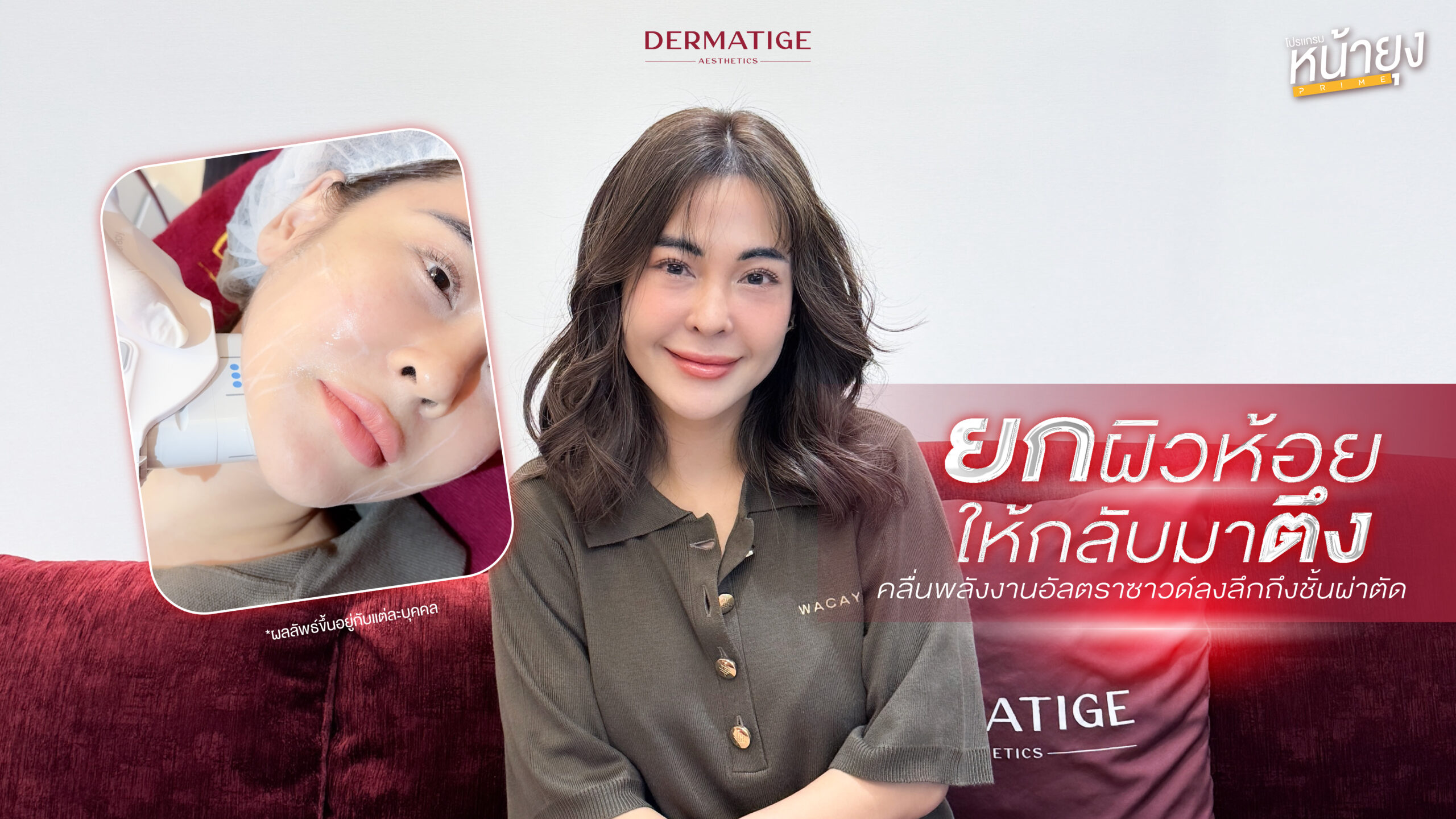 ครั้งแรกในรอบ 45 ปี กับ “โปรแกรมหน้ายุง Prime” ที่ “Dermatige” ถูกใจใช่เลย หน้ายก-เฟิร์มจริง