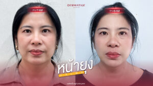 ครั้งแรกในชีวิต คุณแฮม เปิดใจ “โปรแกรมหน้ายุง Prime” ต้นตำรับที่ “Dermatige” ลืมความกลัวไปได้เลย