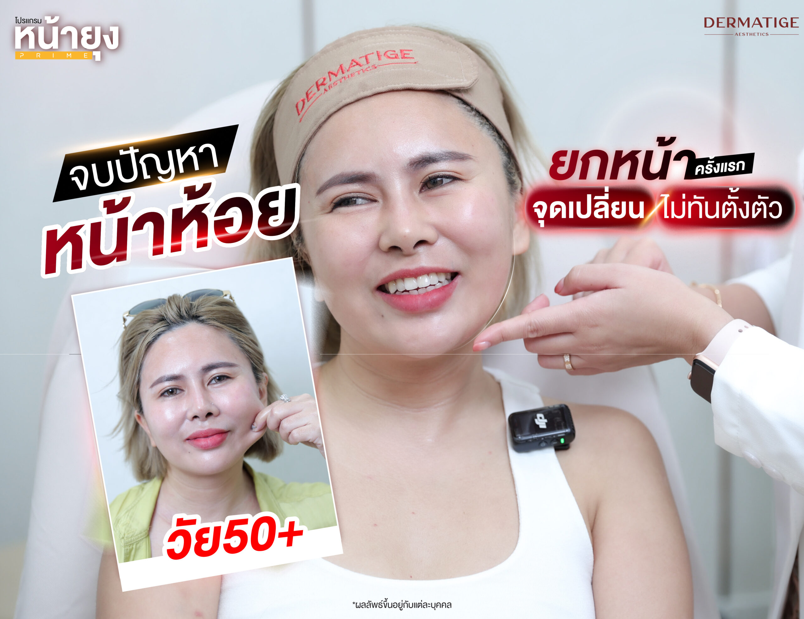 หน้าบาน แก้มห้อย ร่องชัด...ทุกความแก่ แก้ไขได้ด้วย “โปรแกรมหน้ายุง Prime” ที่ “Dermatige” จริงหรือ?