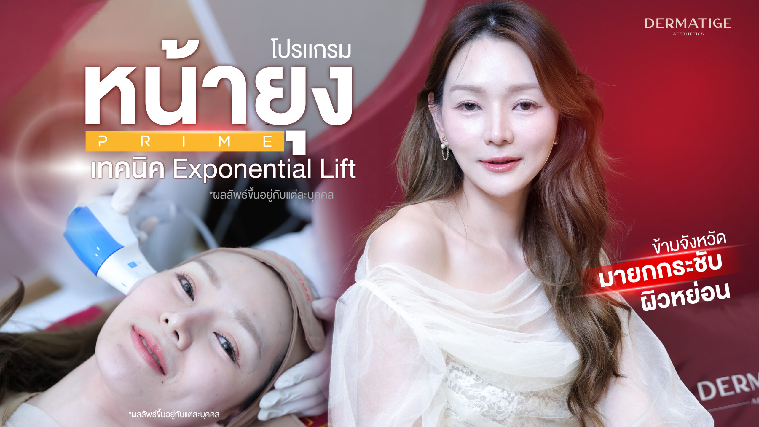 หน้าบาน แก้มห้อย ร่องชัด...ทุกความแก่ แก้ไขได้ด้วย “โปรแกรมหน้ายุง Prime” ที่ “Dermatige” จริงหรือ?