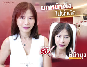 ที่สุดแห่งการบอกต่อจากเพื่อน คุณแอน 40+ พิสูจน์แล้ว “โปรแกรมหน้ายุง Prime” ที่ “Dermatige” ทำแล้วหน้ายกจริง และไม่เจ็บอย่างที่คิด